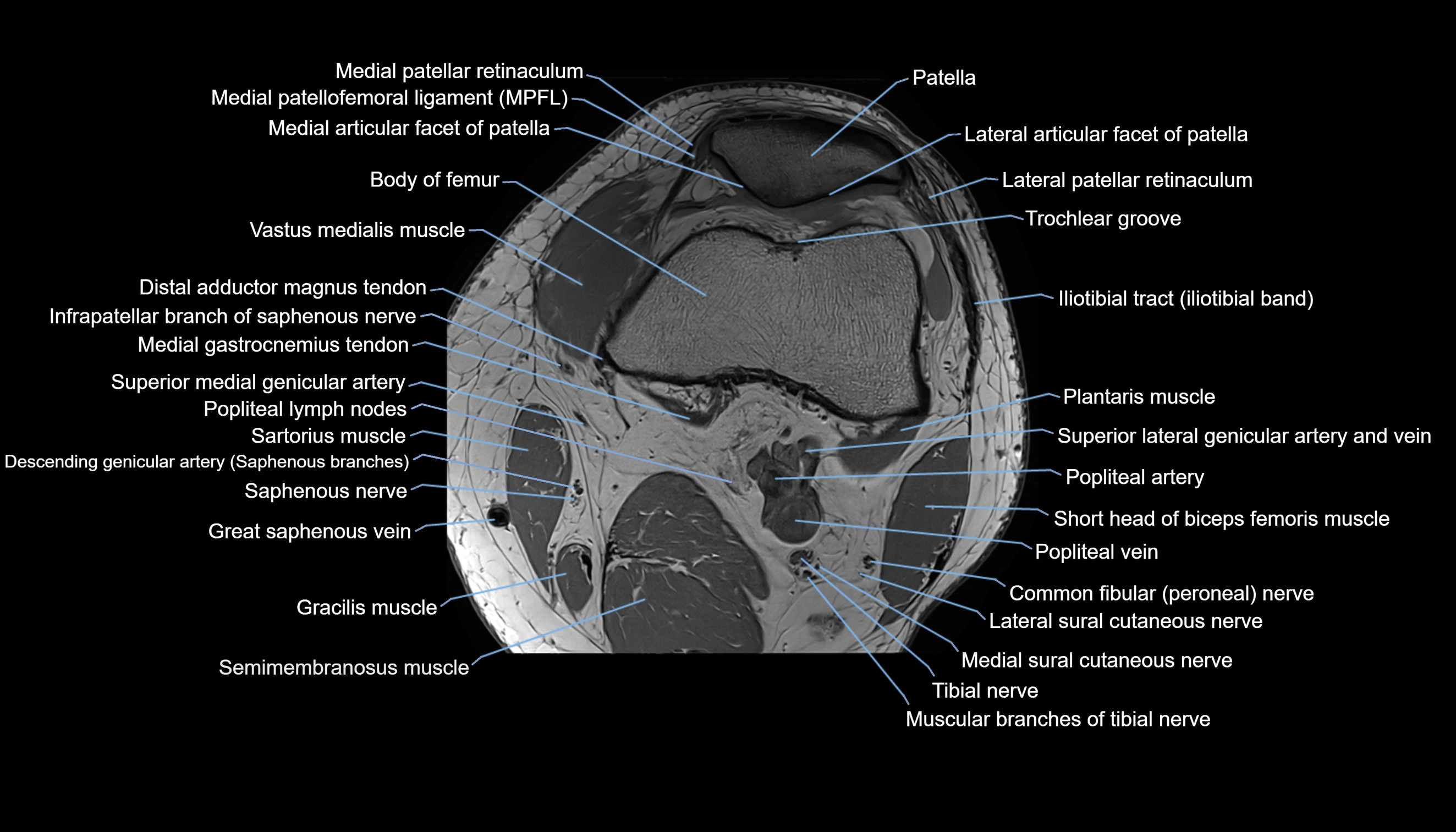 MRI knee  axial cross sectional anatomy 3T radiology  image-img-00001-00012.webp